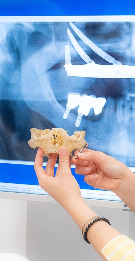 ¿Por qué se reabsorbe el hueso maxilar tras perder los dientes?