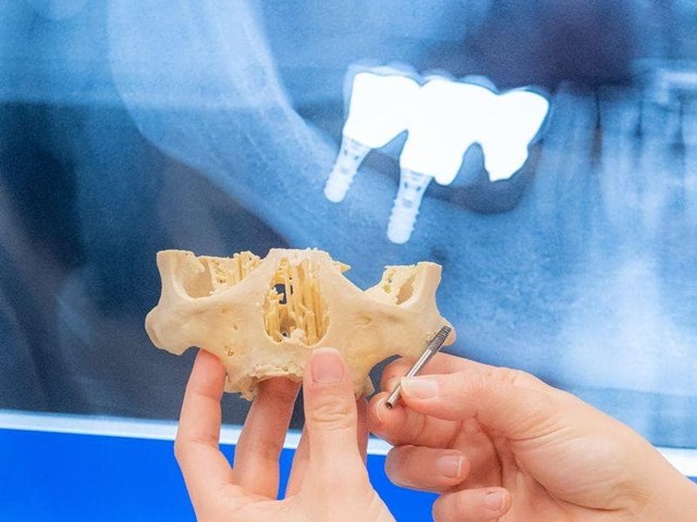 ¿Por qué se reabsorbe el hueso maxilar tras perder los dientes?