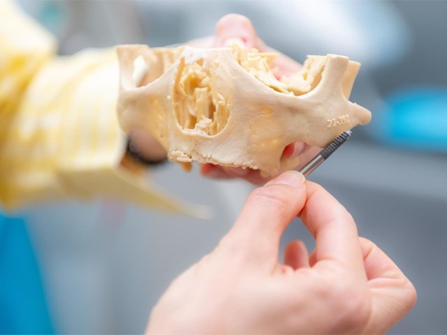 ¿Puedo llevar implantes si llevo años sin dientes?
