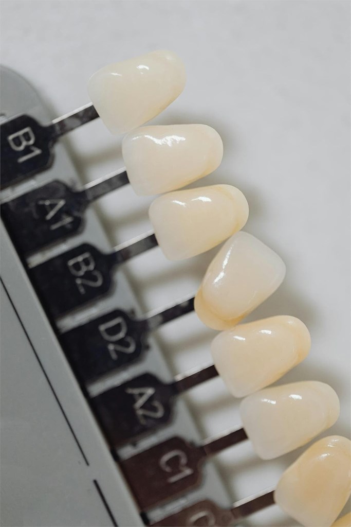 ¿Soy un buen candidato para las carillas dentales?