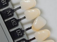 ¿Soy un buen candidato para las carillas dentales?